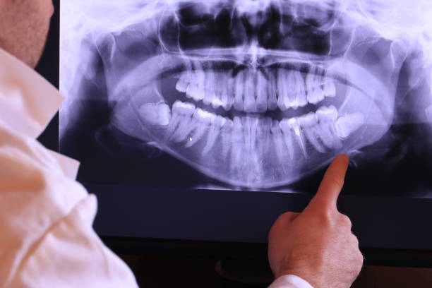 Best Knocked-Out Tooth (Avulsed Tooth) Treatment in Flora, IN