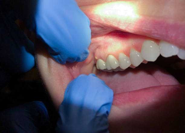 Best Emergency Denture Repair in Flora, IN